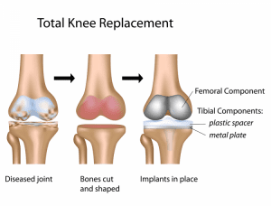 Total Knee Arthroplasty